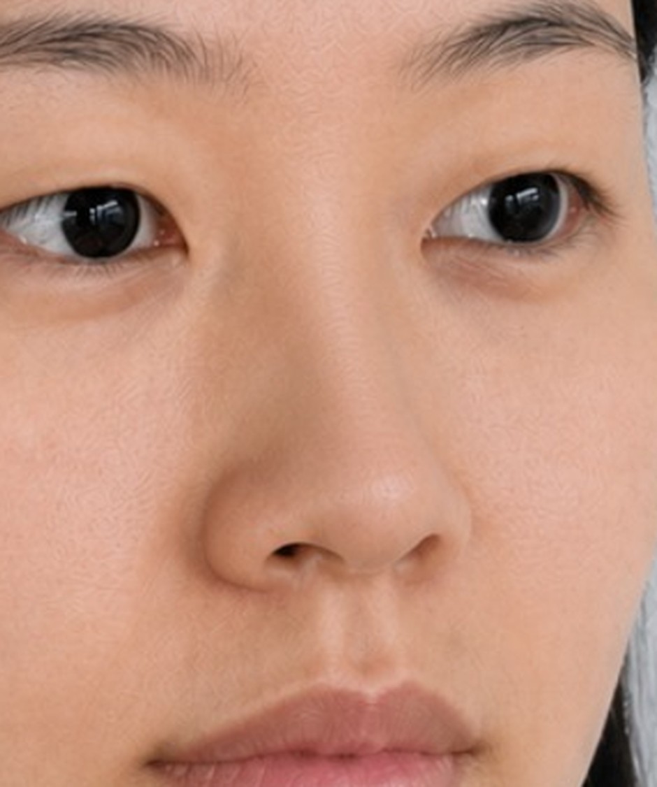 콧대만 — 콧대 라인이 곧고 높아집니다. 코끝은 그대로입니다.