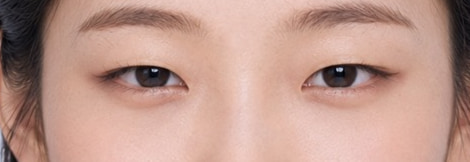 원본 — 시술 전. 검은자 위쪽이 눈꺼풀에 가려져 있습니다.