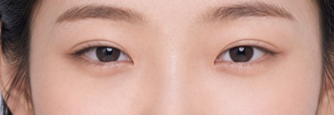 쌍꺼풀만 — 선은 생겼지만 눈이 떠지는 정도는 거의 그대로입니다.