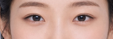 In-line crease, eye close-up